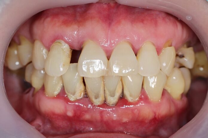 Find out about Periodontal Disease
