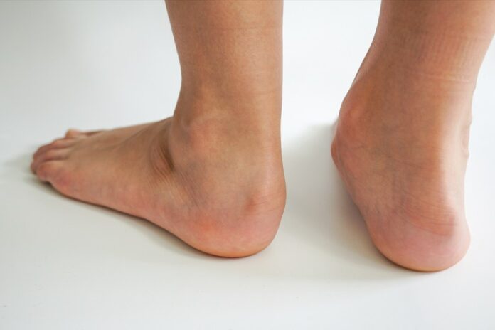 Skewfoot